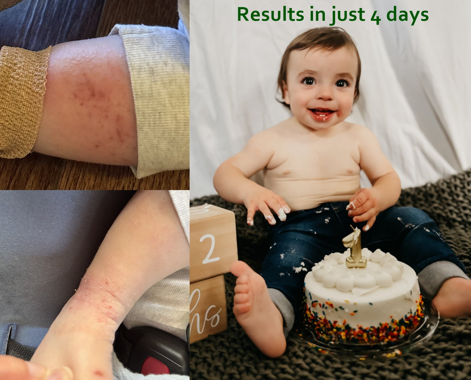 baby with severe dry skin patches which may resemble eczema and results showing fully cleared in 4 days